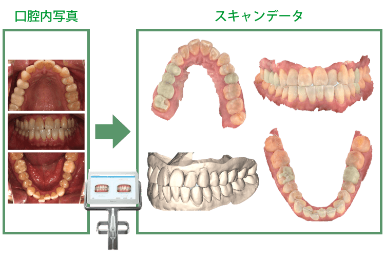 術前口腔内のデータ化