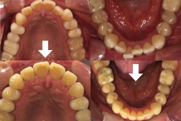 上下叢生（上下前歯〜小臼歯の凸凹）