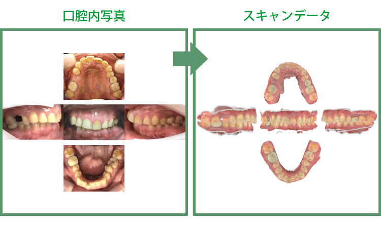 術前口腔内のデータ化